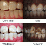 Photographs of Dental Fluorosis by Dr. Hardy Limeback and Dr. Iain Pretty, et al.